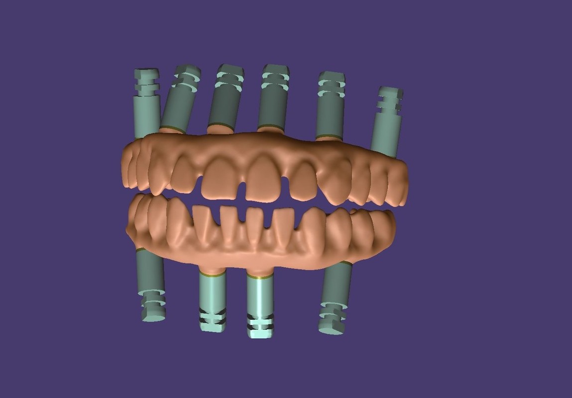 BEOGRAD - EXOCAD – Most na implantatima