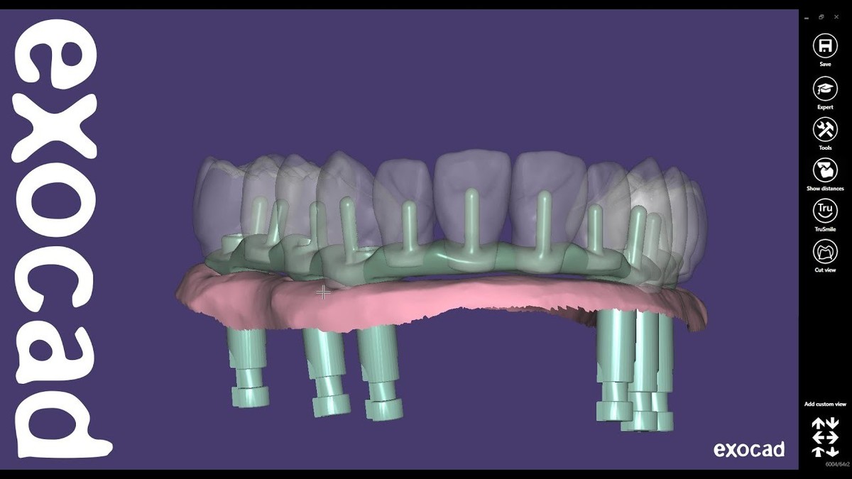 EXOCAD – Most na implantatima