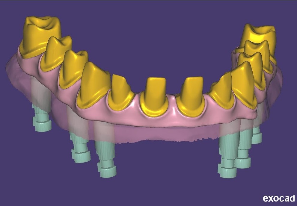 EXOCAD – Most na implantatima