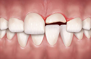 Zubna travmatologija